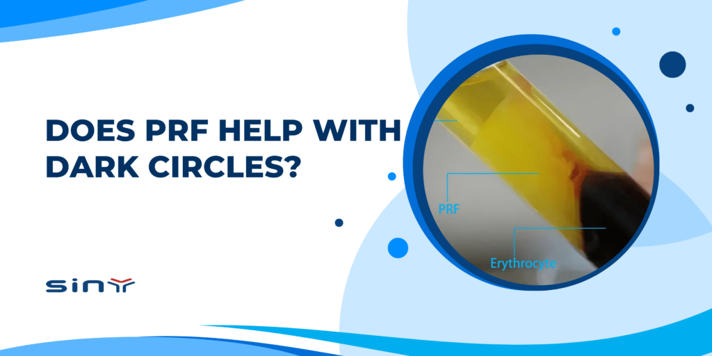 Does PRF Help with Dark Circles
