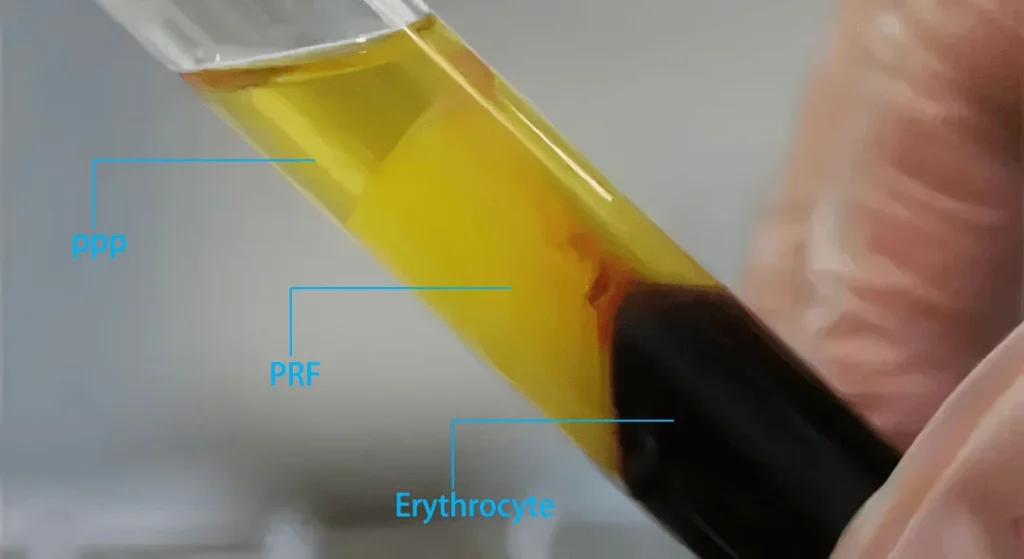 Platelet-Rich-Fibrin-PRF