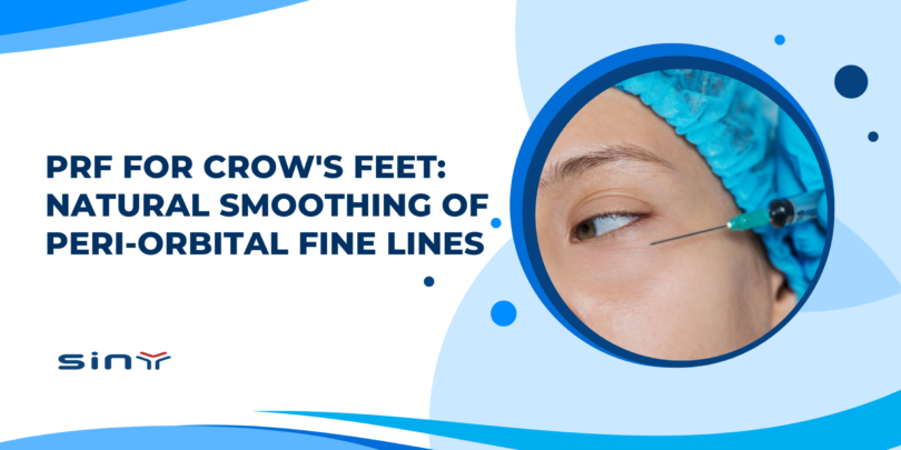 PRF for Crow's Feet